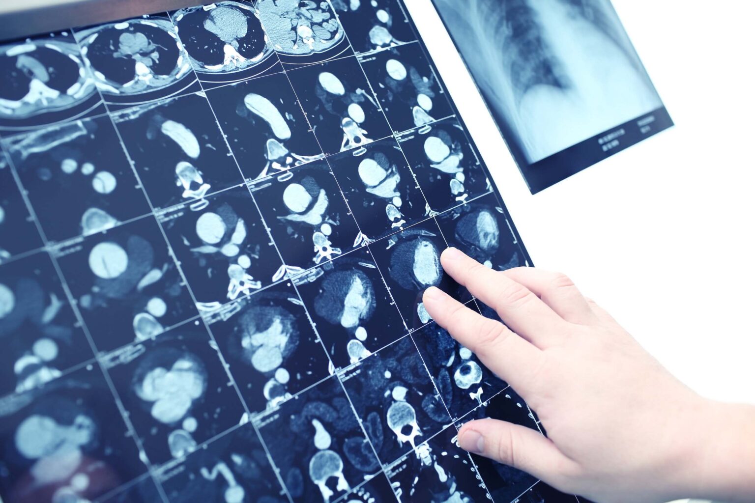 CT Calcium Scoring - Hackensack Radiology